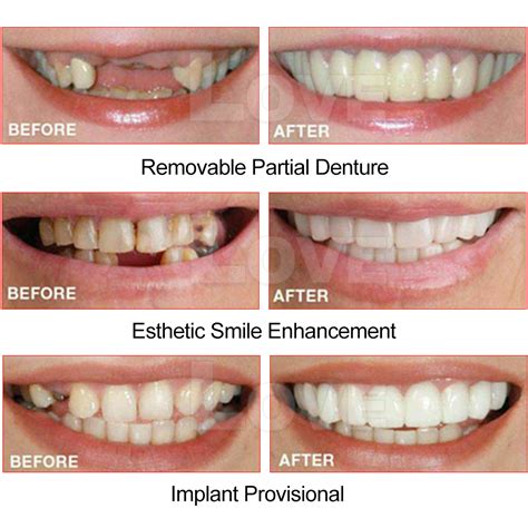 how much are fake teeth in canada